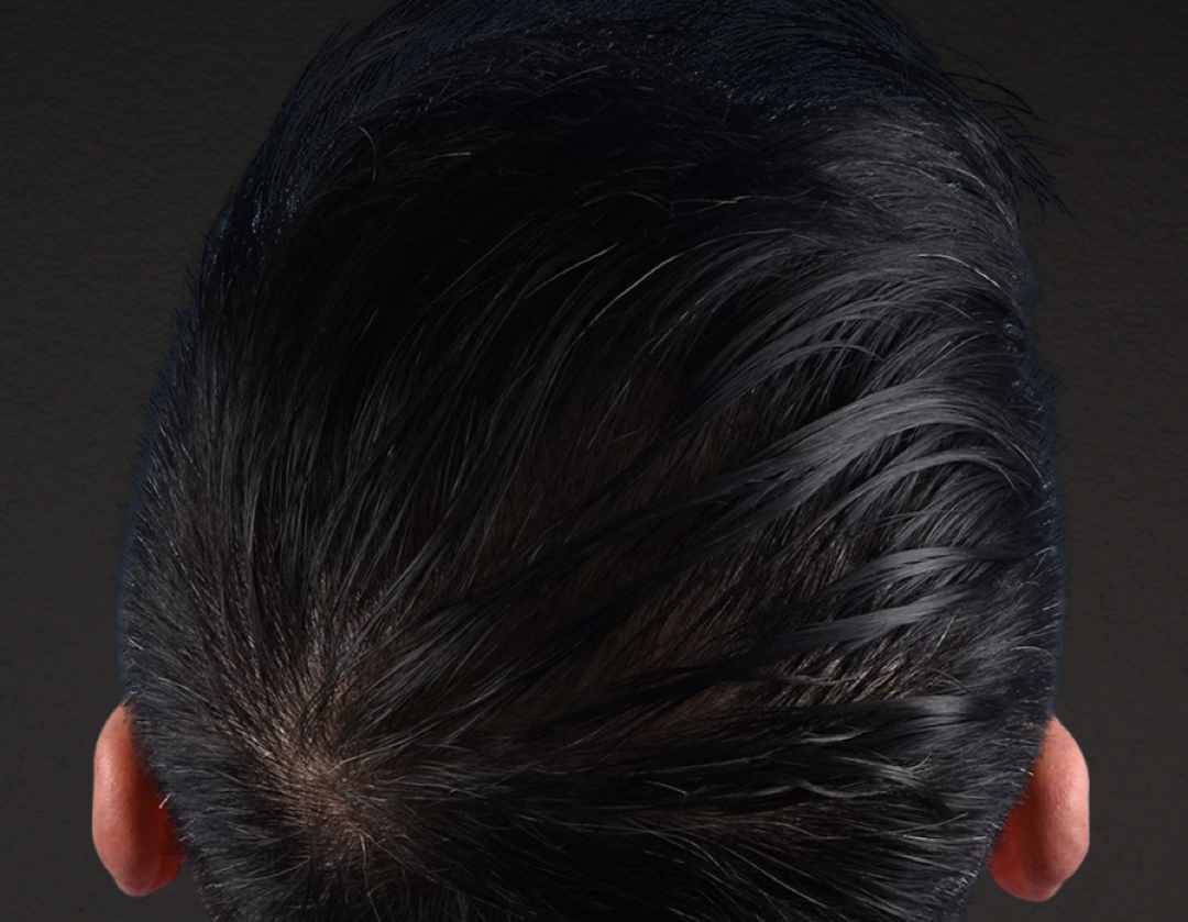 Hair Transplant With NeoGraft Before & After Gallery - Patient 242971 - Image 4