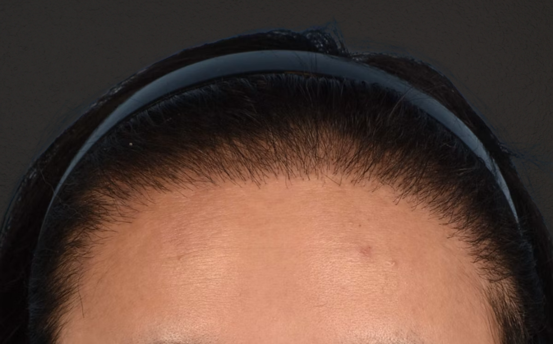 Hair Transplant With NeoGraft Before & After Gallery - Patient 984625 - Image 2