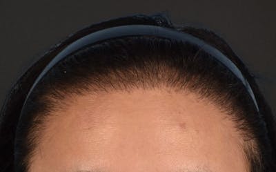 Hair Transplant With NeoGraft Before & After Gallery - Patient 984625 - Image 2