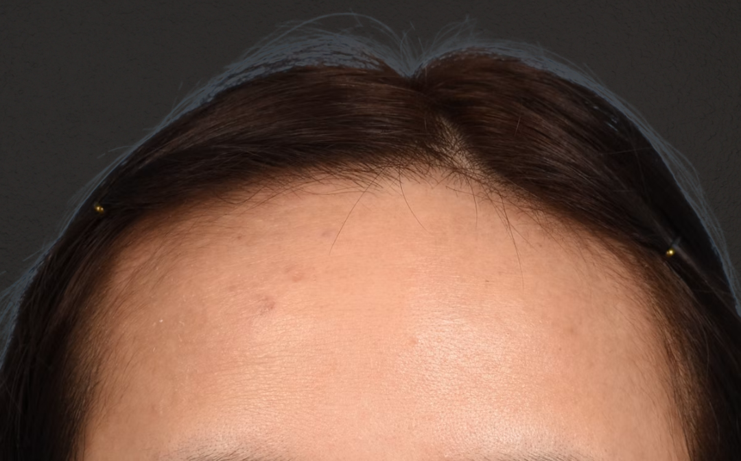 Hair Transplant With NeoGraft Before & After Gallery - Patient 984625 - Image 1