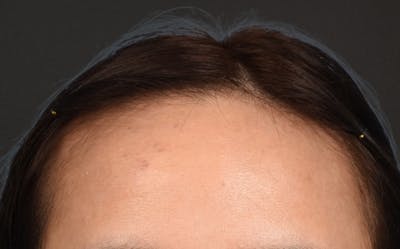 Hair Transplant With NeoGraft Before & After Gallery - Patient 984625 - Image 1