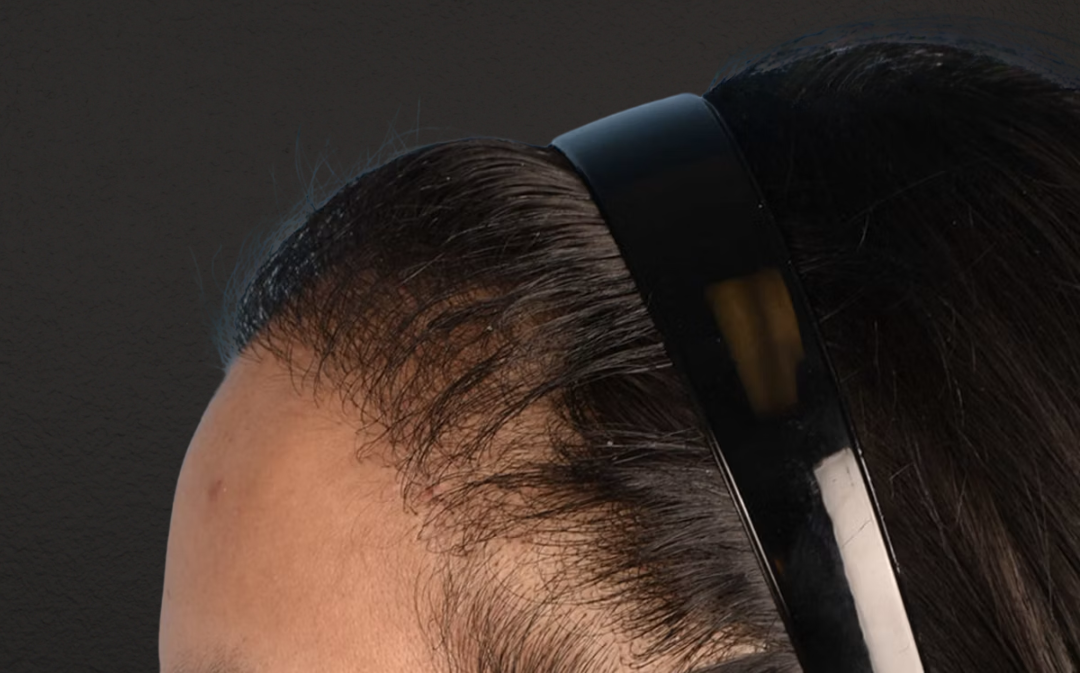 Hair Transplant With NeoGraft Before & After Gallery - Patient 984625 - Image 8