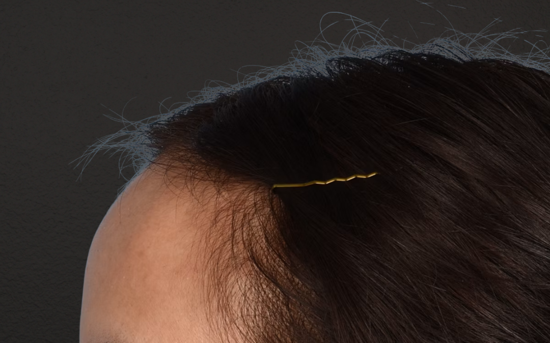 Hair Transplant With NeoGraft Before & After Gallery - Patient 984625 - Image 7