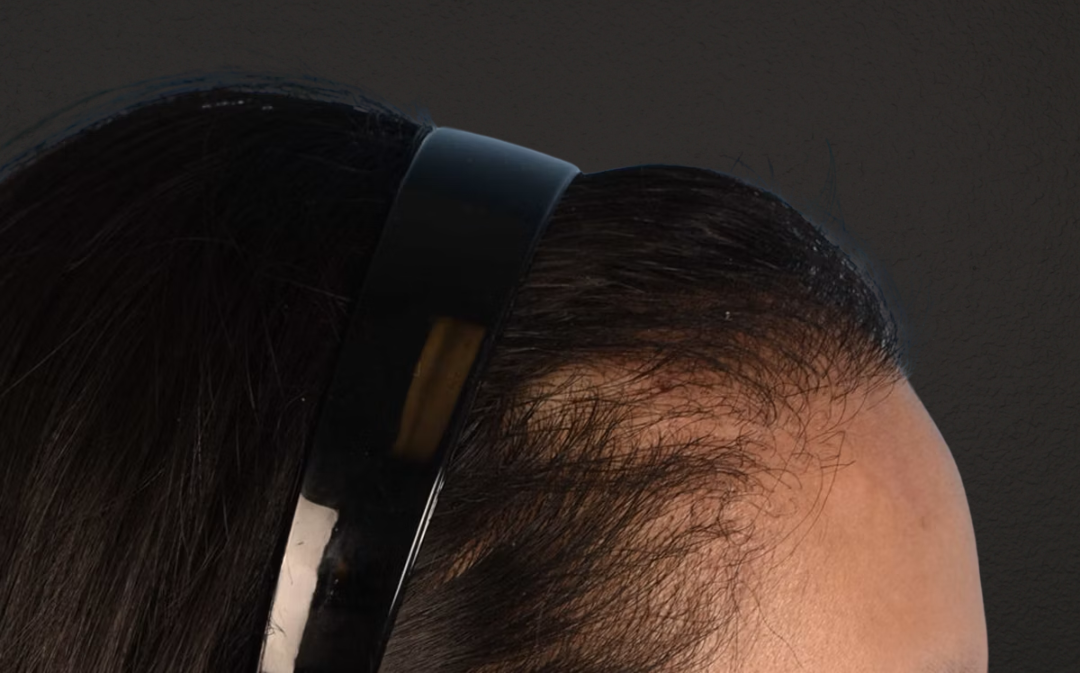 Hair Transplant With NeoGraft Before & After Gallery - Patient 984625 - Image 6