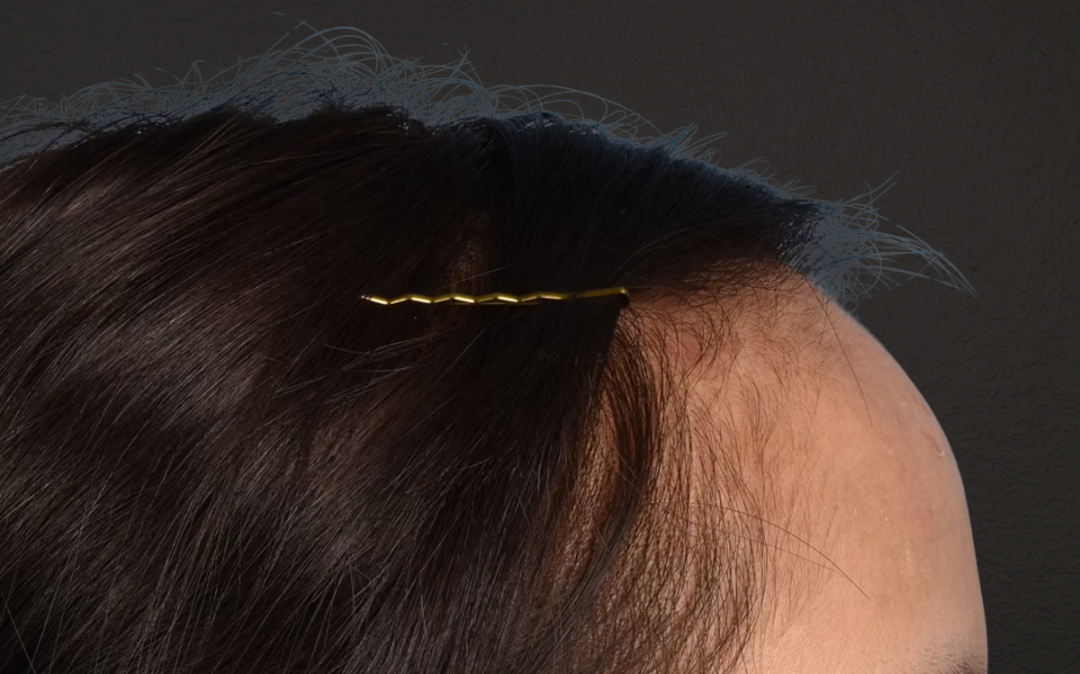 Hair Transplant With NeoGraft Before & After Gallery - Patient 984625 - Image 5