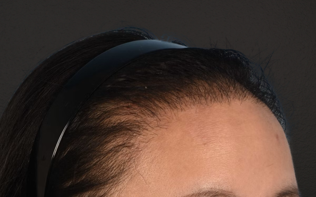 Hair Transplant With NeoGraft Before & After Gallery - Patient 984625 - Image 4