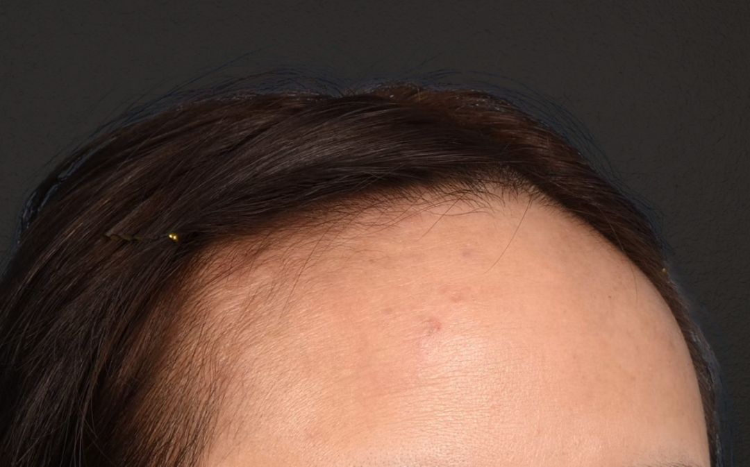 Hair Transplant With NeoGraft Before & After Gallery - Patient 984625 - Image 3