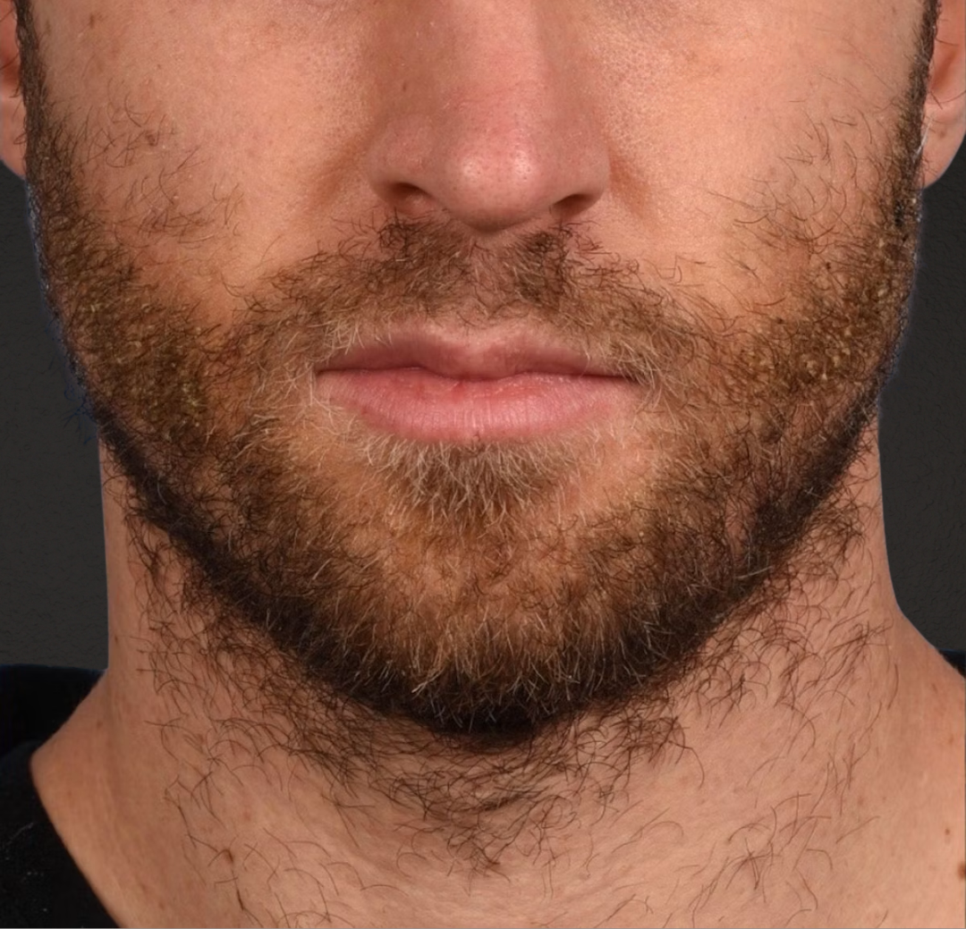 Hair Transplant With NeoGraft Before & After Gallery - Patient 326874 - Image 2