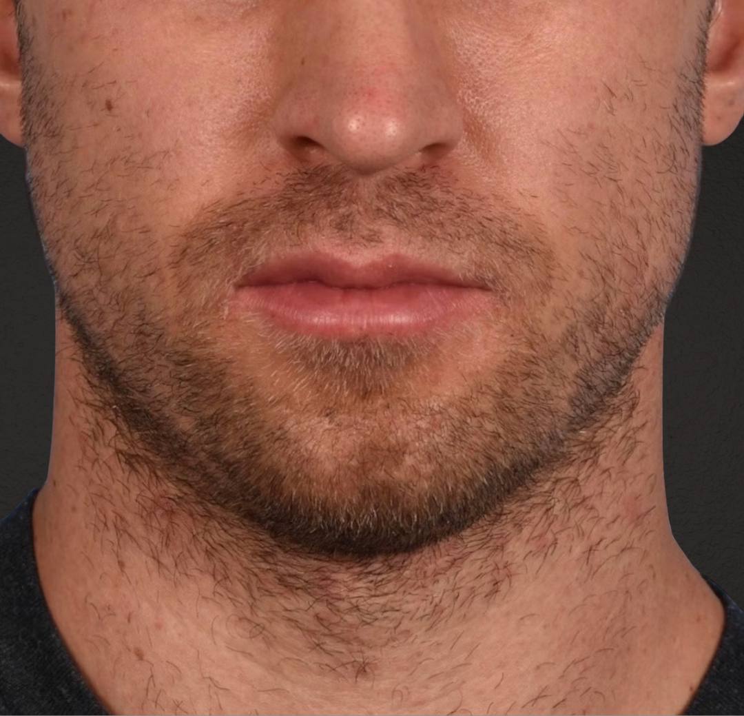 Hair Transplant With NeoGraft Before & After Gallery - Patient 326874 - Image 1