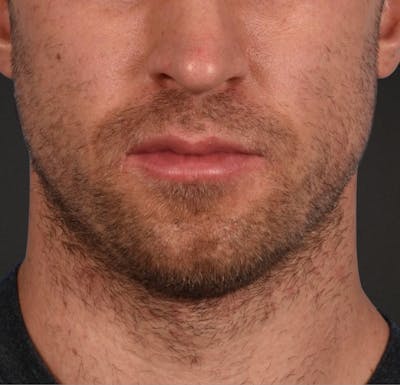 Hair Transplant With NeoGraft Before & After Gallery - Patient 326874 - Image 1