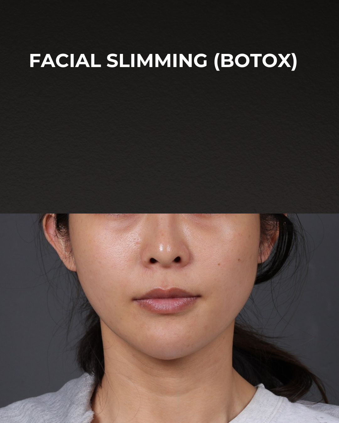 Botox and Dysport Before & After Gallery - Patient 206319 - Image 2