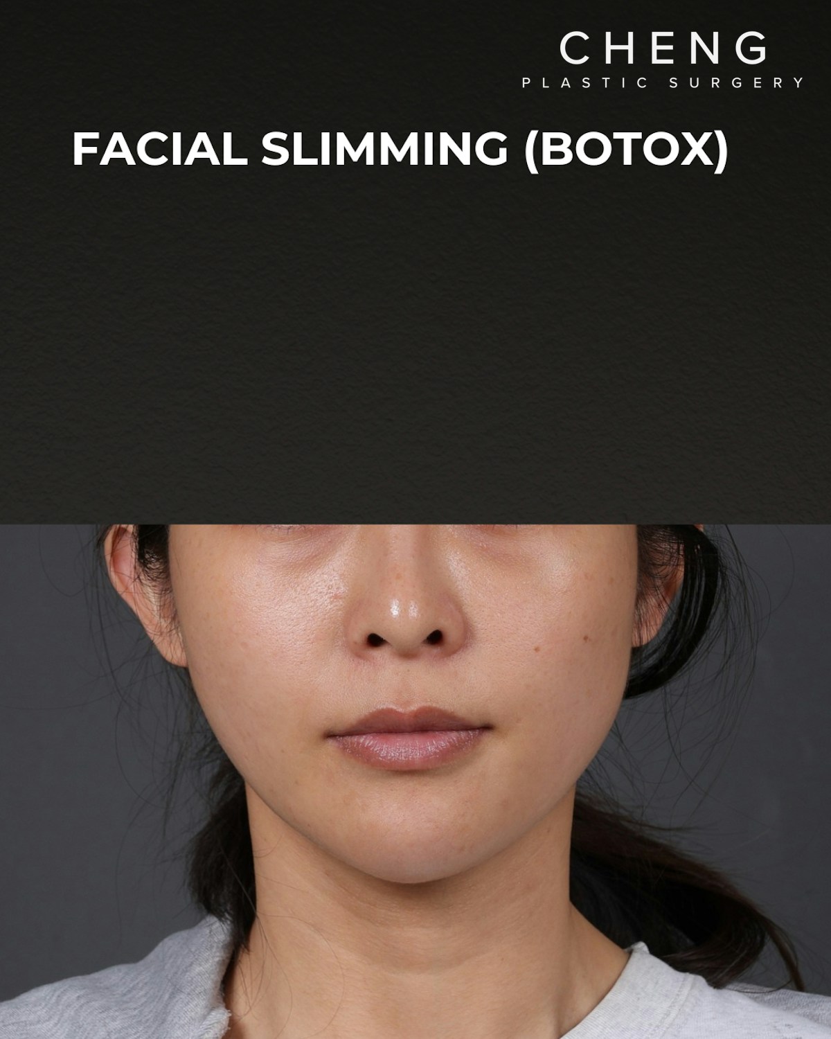 Botox and Dysport Before & After Gallery - Patient 206319 - Image 2