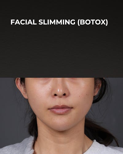 Botox and Dysport Before & After Gallery - Patient 206319 - Image 2