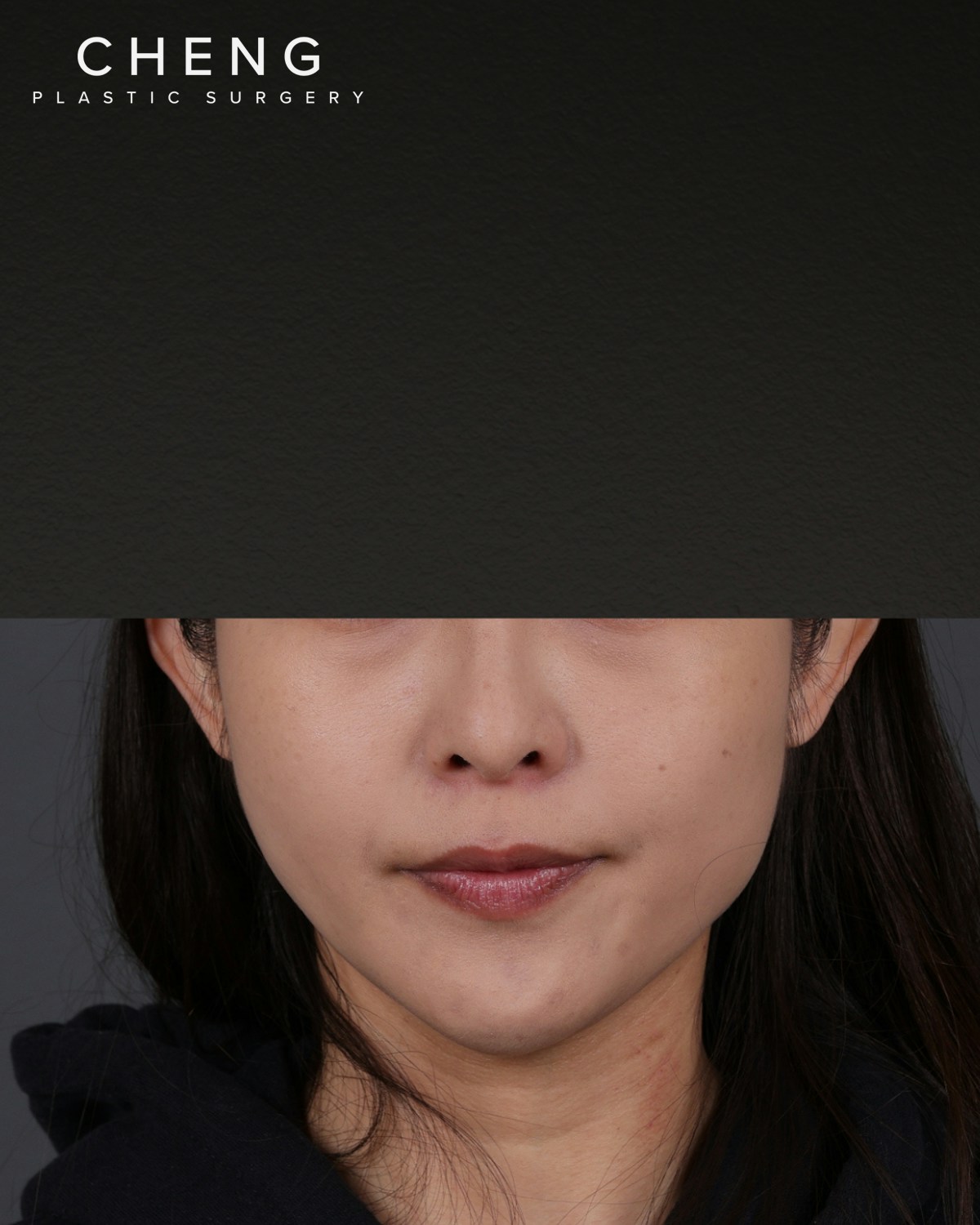 Botox and Dysport Before & After Gallery - Patient 206319 - Image 1