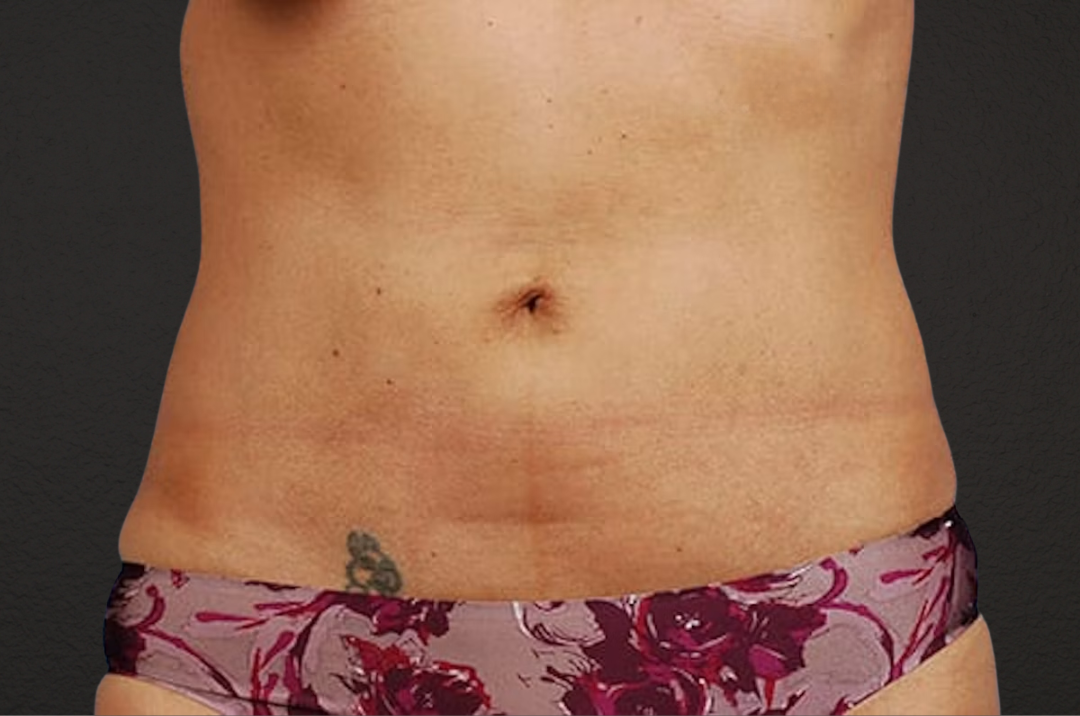 Liposuction Before & After Gallery - Patient 290094 - Image 2