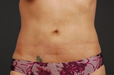 Liposuction Before & After Gallery - Patient 290094 - Image 2