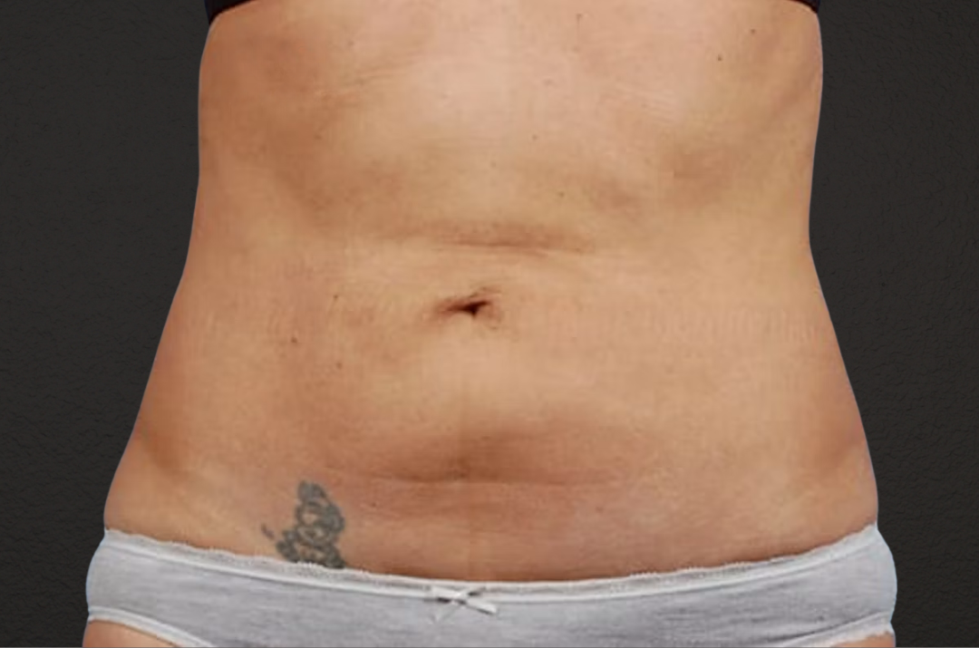 Liposuction Before & After Gallery - Patient 290094 - Image 1
