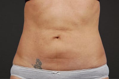 Liposuction Before & After Gallery - Patient 290094 - Image 1