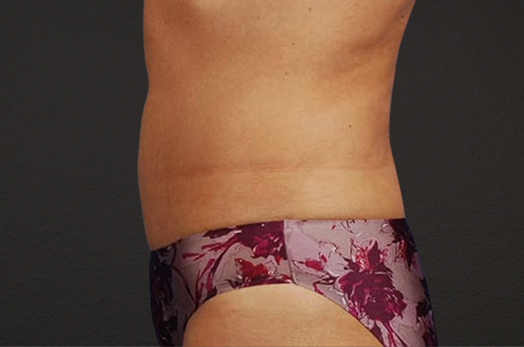 Liposuction Before & After Gallery - Patient 290094 - Image 6