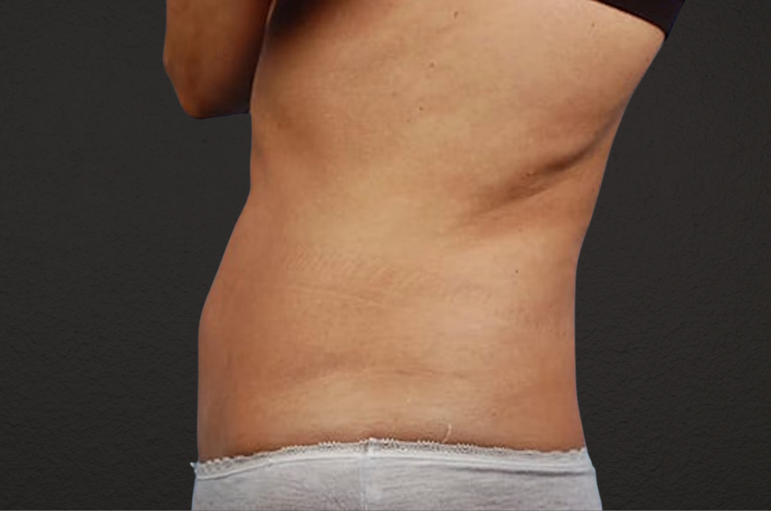Liposuction Before & After Gallery - Patient 290094 - Image 5