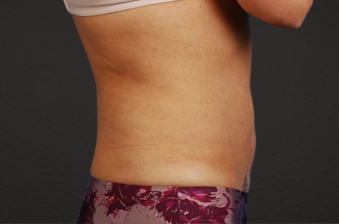 Liposuction Before & After Gallery - Patient 290094 - Image 4