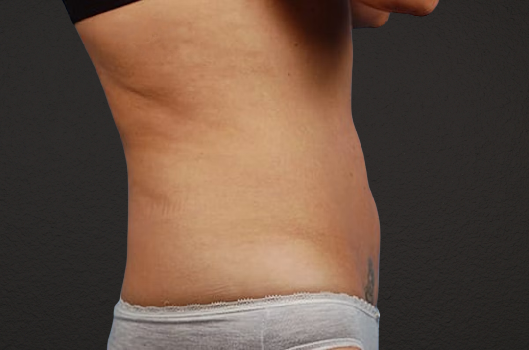 Liposuction Before & After Gallery - Patient 290094 - Image 3