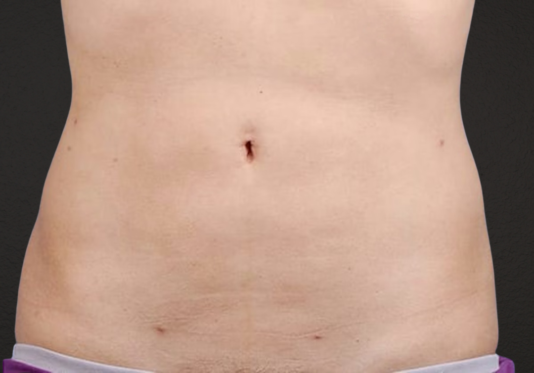 Liposuction Before & After Gallery - Patient 406129 - Image 2
