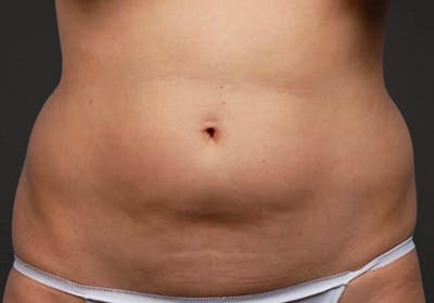 Liposuction Before & After Gallery - Patient 406129 - Image 1