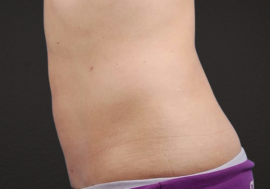 Liposuction Before & After Gallery - Patient 406129 - Image 4