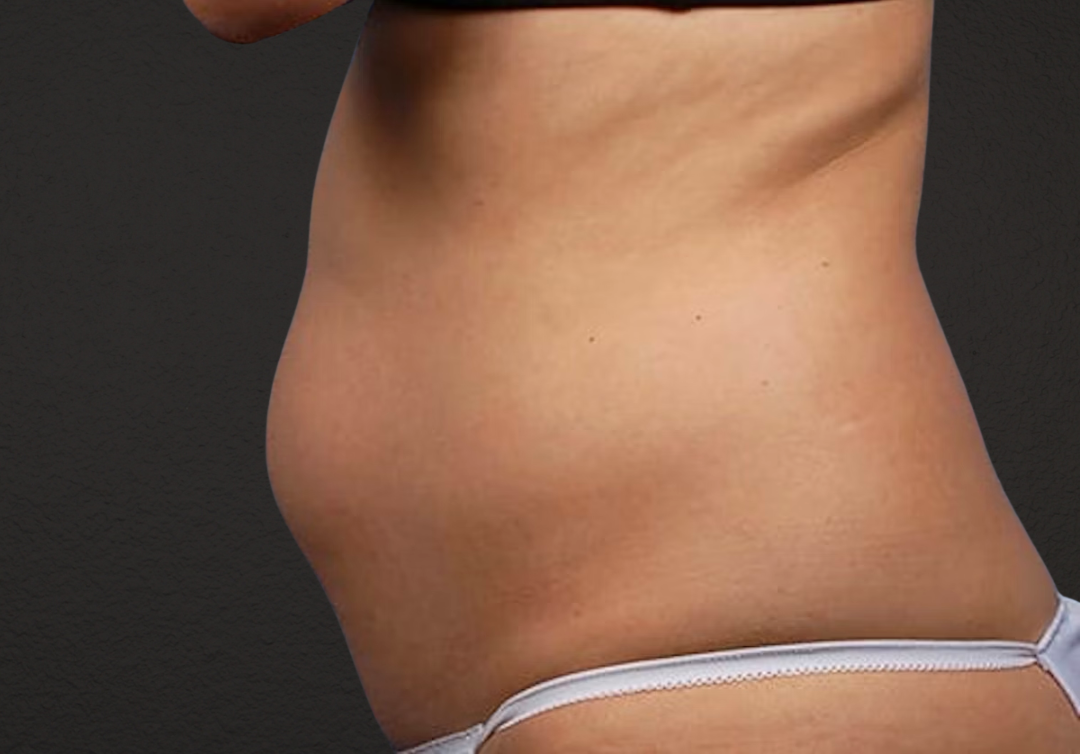 Liposuction Before & After Gallery - Patient 406129 - Image 3