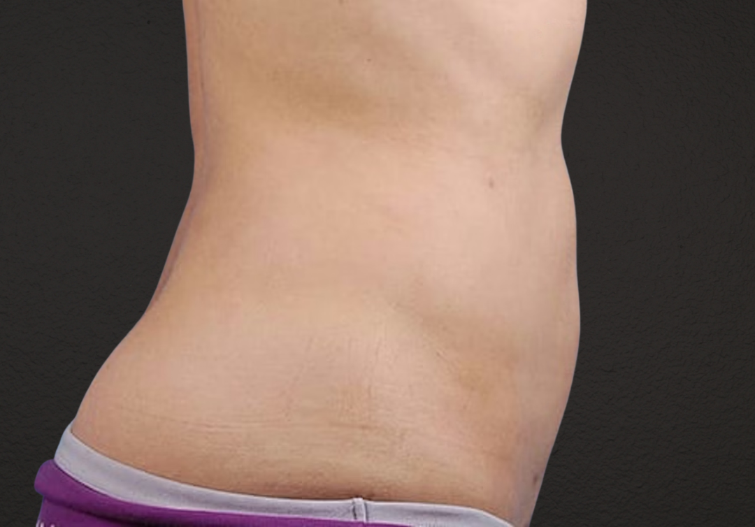 Liposuction Before & After Gallery - Patient 406129 - Image 6