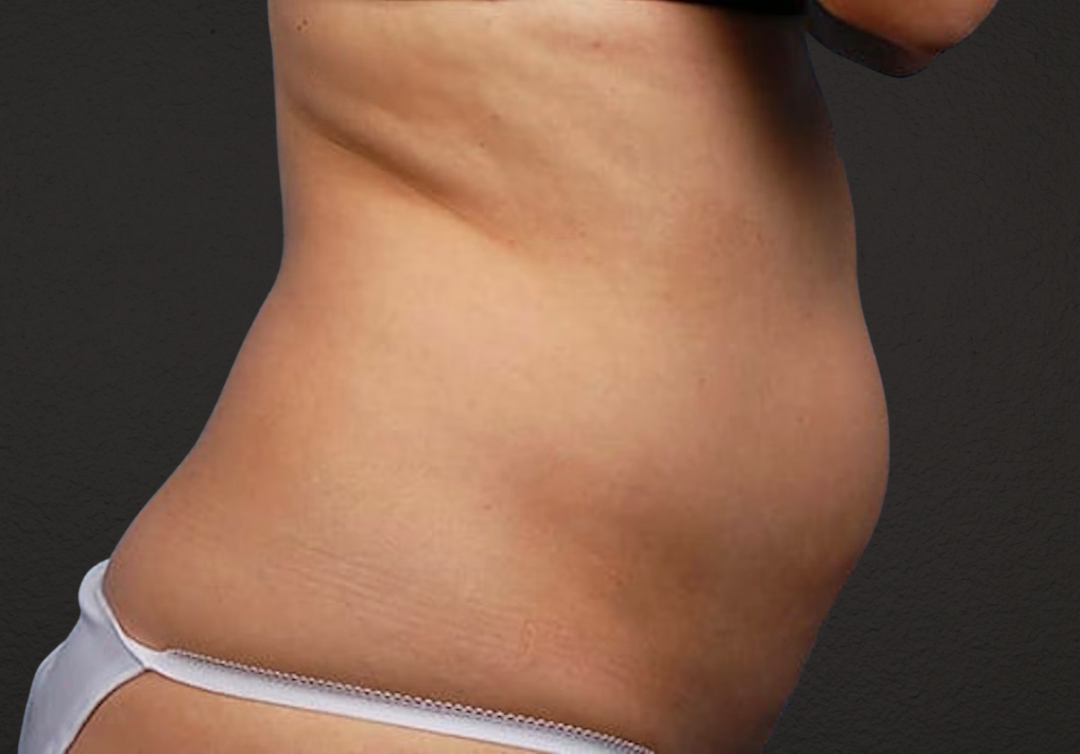 Liposuction Before & After Gallery - Patient 406129 - Image 5