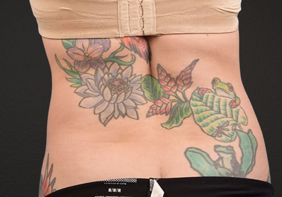 Liposuction Before & After Gallery - Patient 301902 - Image 8