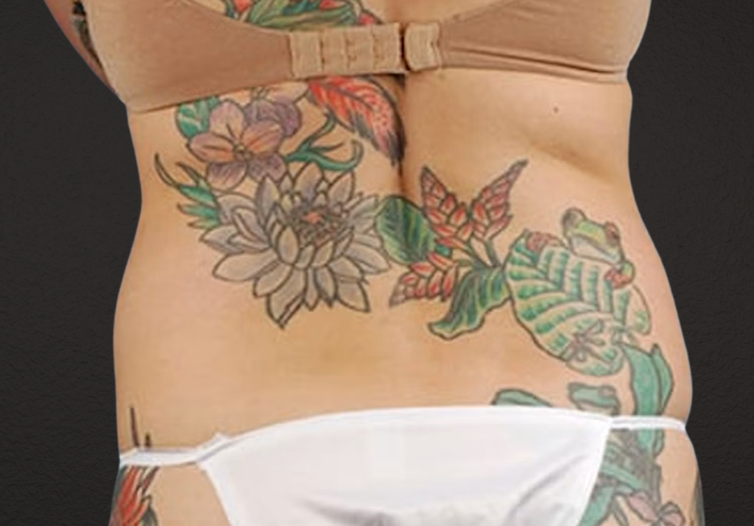 Liposuction Before & After Gallery - Patient 301902 - Image 7