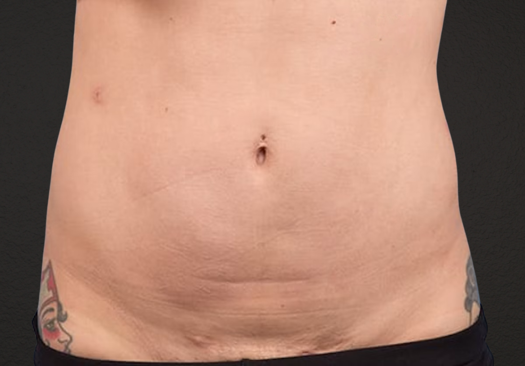 Liposuction Before & After Gallery - Patient 301902 - Image 2