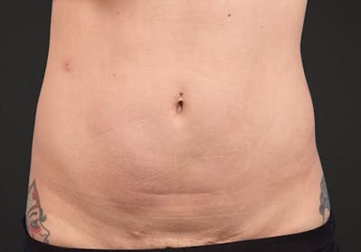 Liposuction Before & After Gallery - Patient 301902 - Image 2