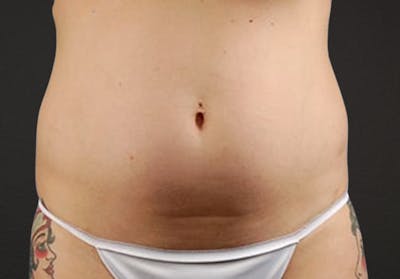 Liposuction Before & After Gallery - Patient 301902 - Image 1