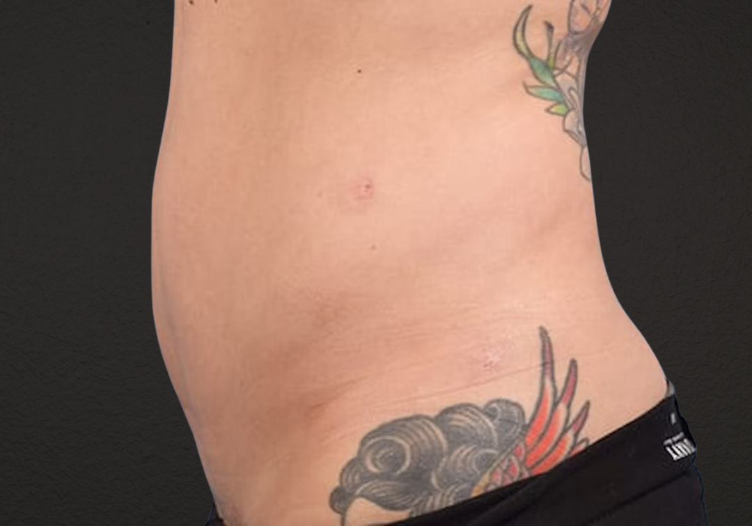 Liposuction Before & After Gallery - Patient 301902 - Image 4