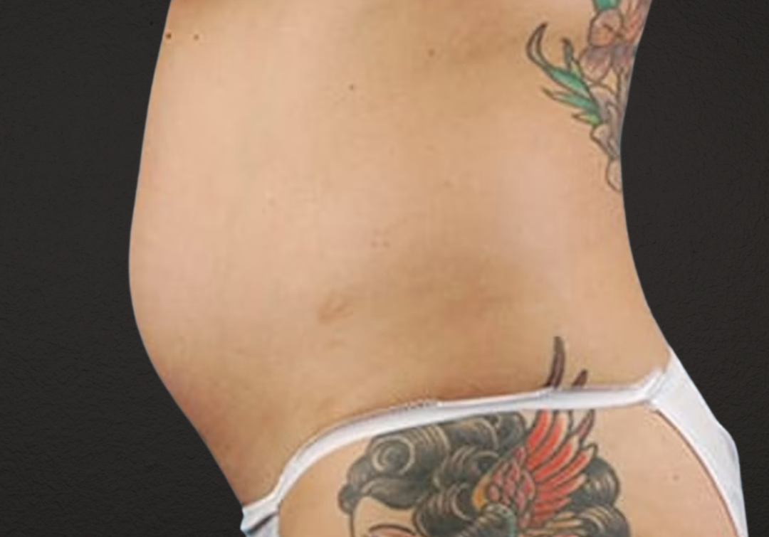 Liposuction Before & After Gallery - Patient 301902 - Image 3