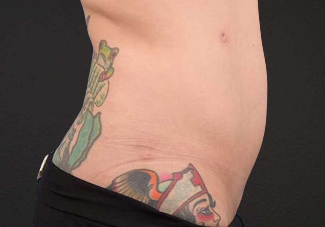 Liposuction Before & After Gallery - Patient 301902 - Image 6
