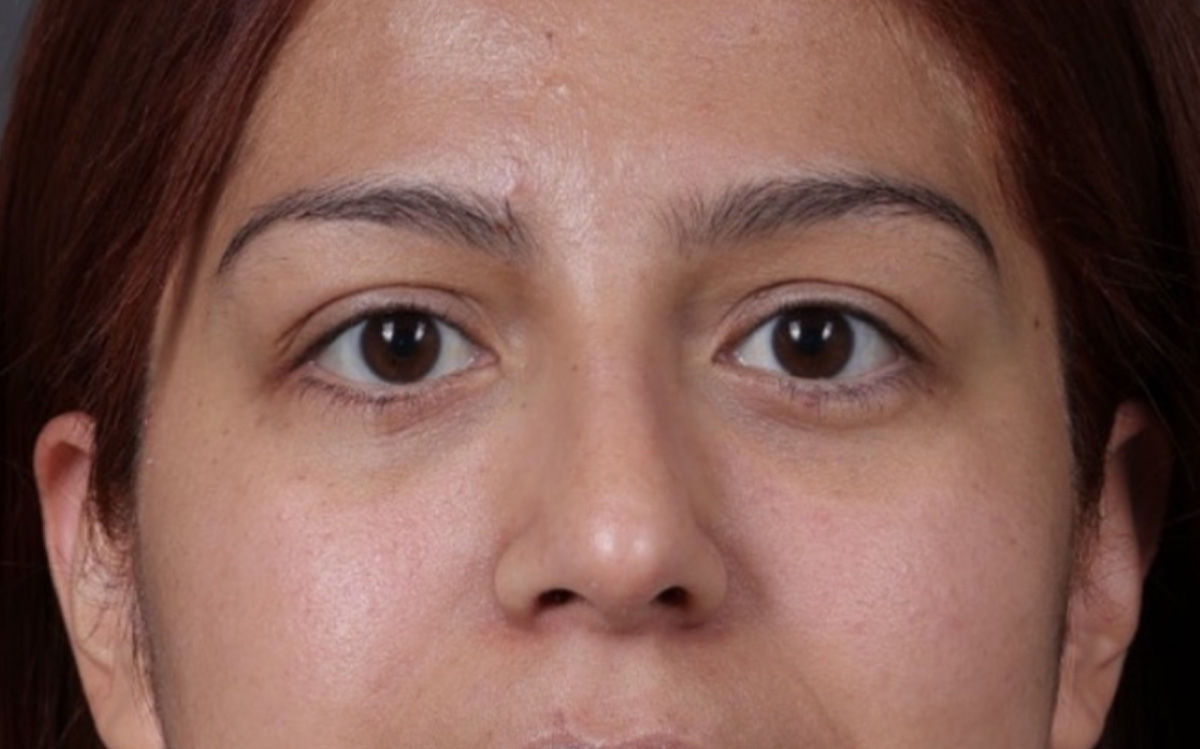 Blepharoplasty Before & After Gallery - Patient 228493 - Image 2