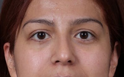 Blepharoplasty Before & After Gallery - Patient 228493 - Image 2