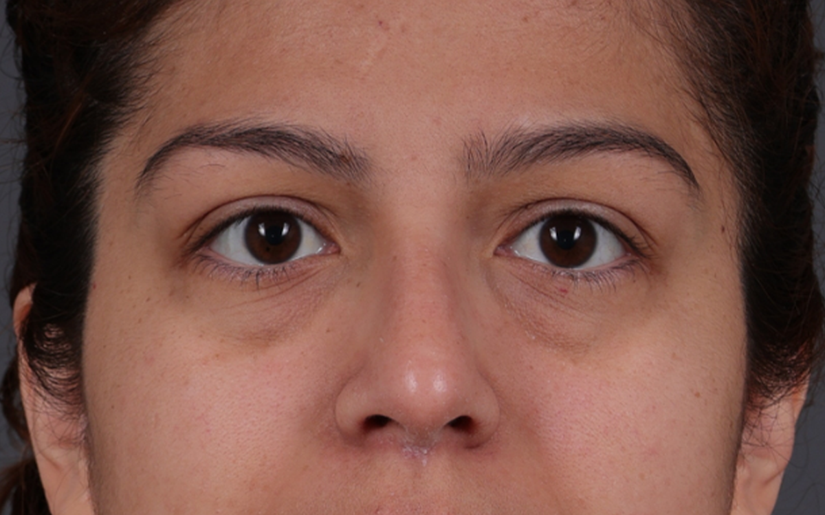 Blepharoplasty Before & After Gallery - Patient 228493 - Image 1