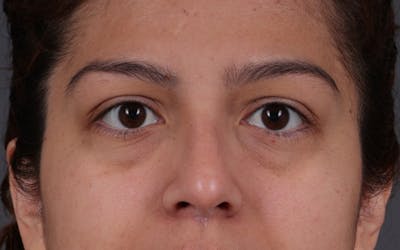 Blepharoplasty Before & After Gallery - Patient 228493 - Image 1