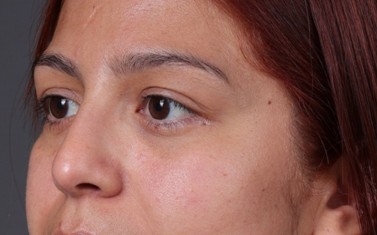 Blepharoplasty Before & After Gallery - Patient 228493 - Image 6