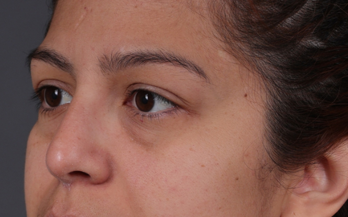 Blepharoplasty Before & After Gallery - Patient 228493 - Image 5