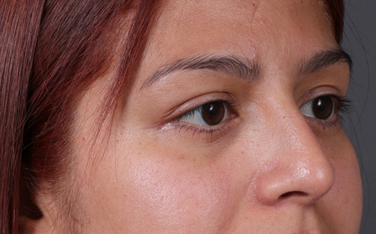 Blepharoplasty Before & After Gallery - Patient 228493 - Image 4