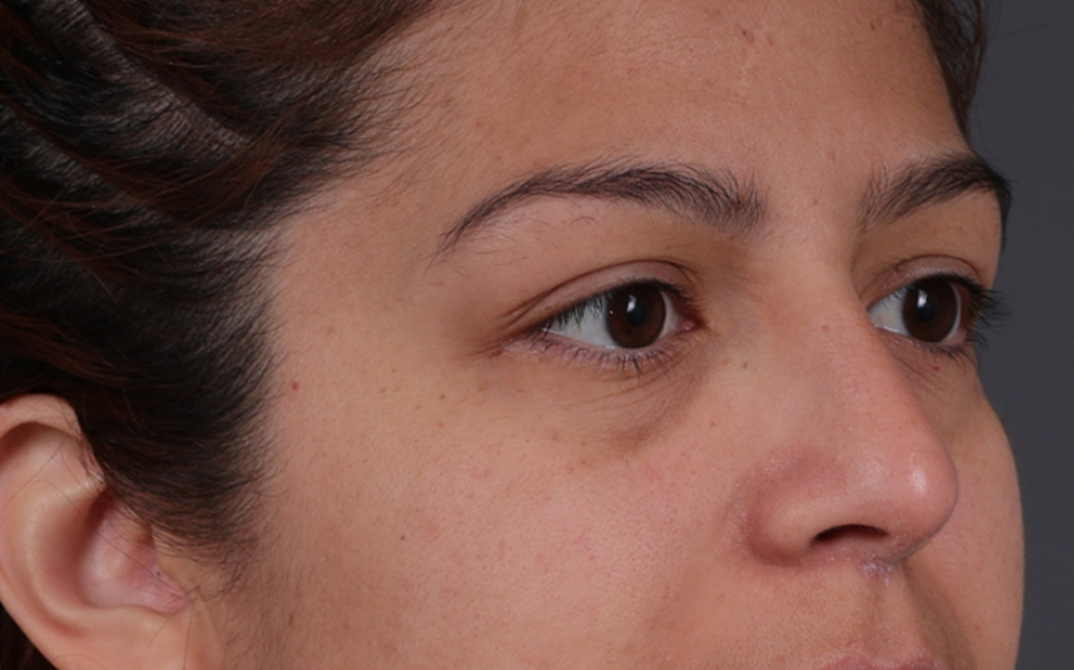 Blepharoplasty Before & After Gallery - Patient 228493 - Image 3