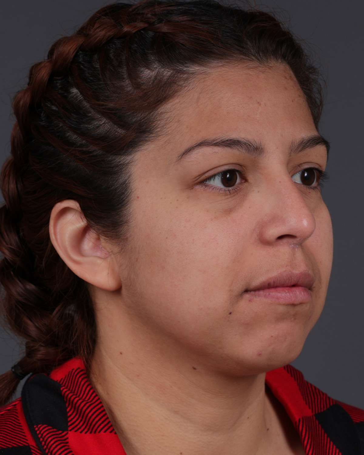 Fat Grafting Before & After Gallery - Patient 397263 - Image 3