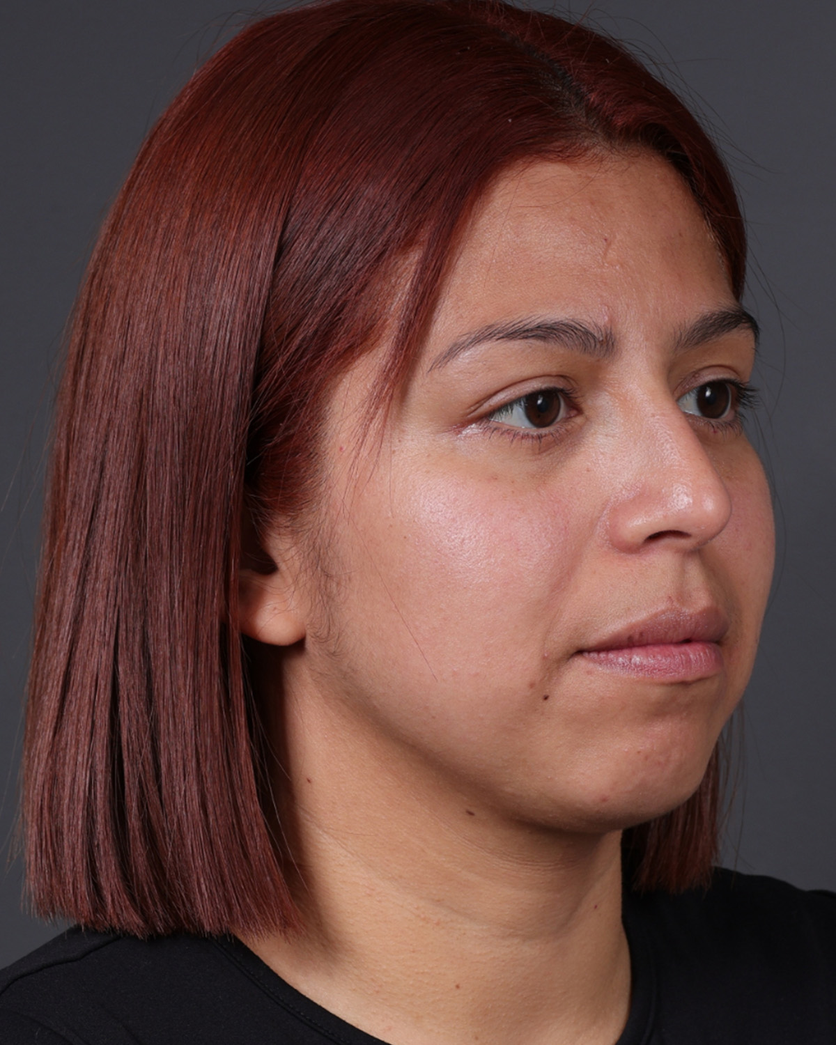 Fat Grafting Before & After Gallery - Patient 397263 - Image 4
